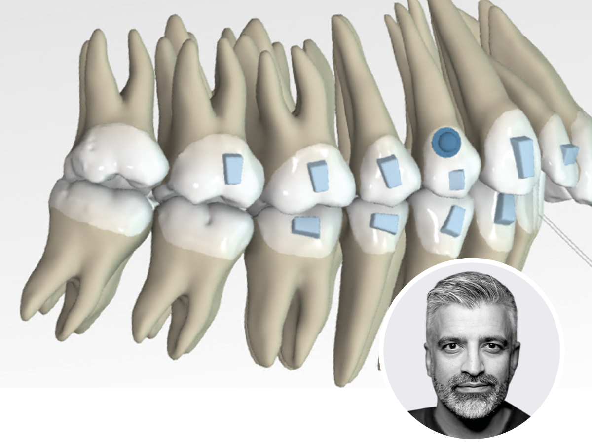 Modjaw - Anwendung digitaler Jaw Tracking Systeme